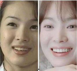 明星做烤瓷牙怎么做