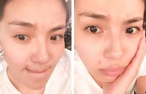 明星皮肤长痘痘,揭秘皮肤长痘痘的护肤攻略