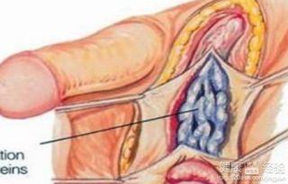 精索静脉曲明星